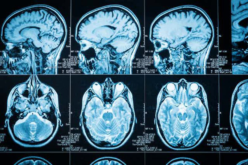 Covid-19 ტვინის დაავადებების განვითარების მეტ რისკს ქმნის, ვიდრე ვაქცინა - კვლევა